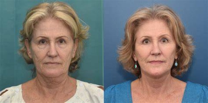 before-and-after-1